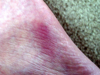 edge of foot